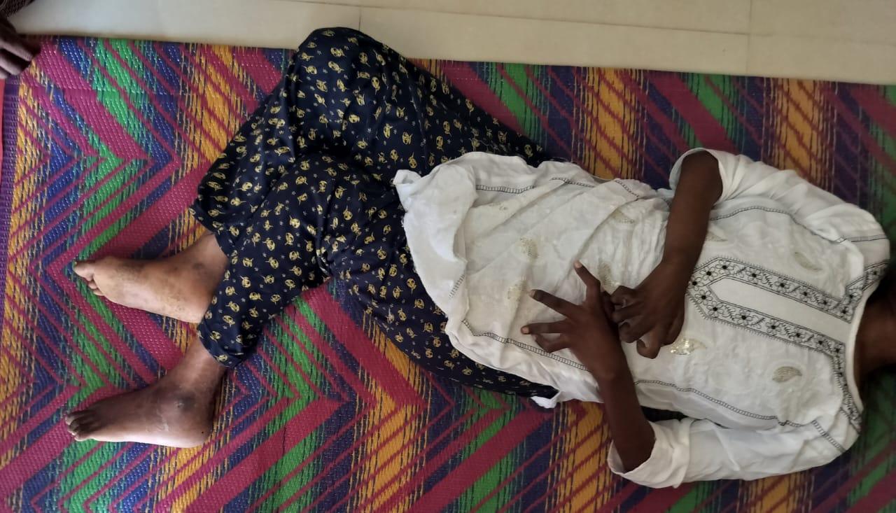 32F Severe deforming Rheumatoid Arthritis , bedridden 15 yrs Telangana PaJR