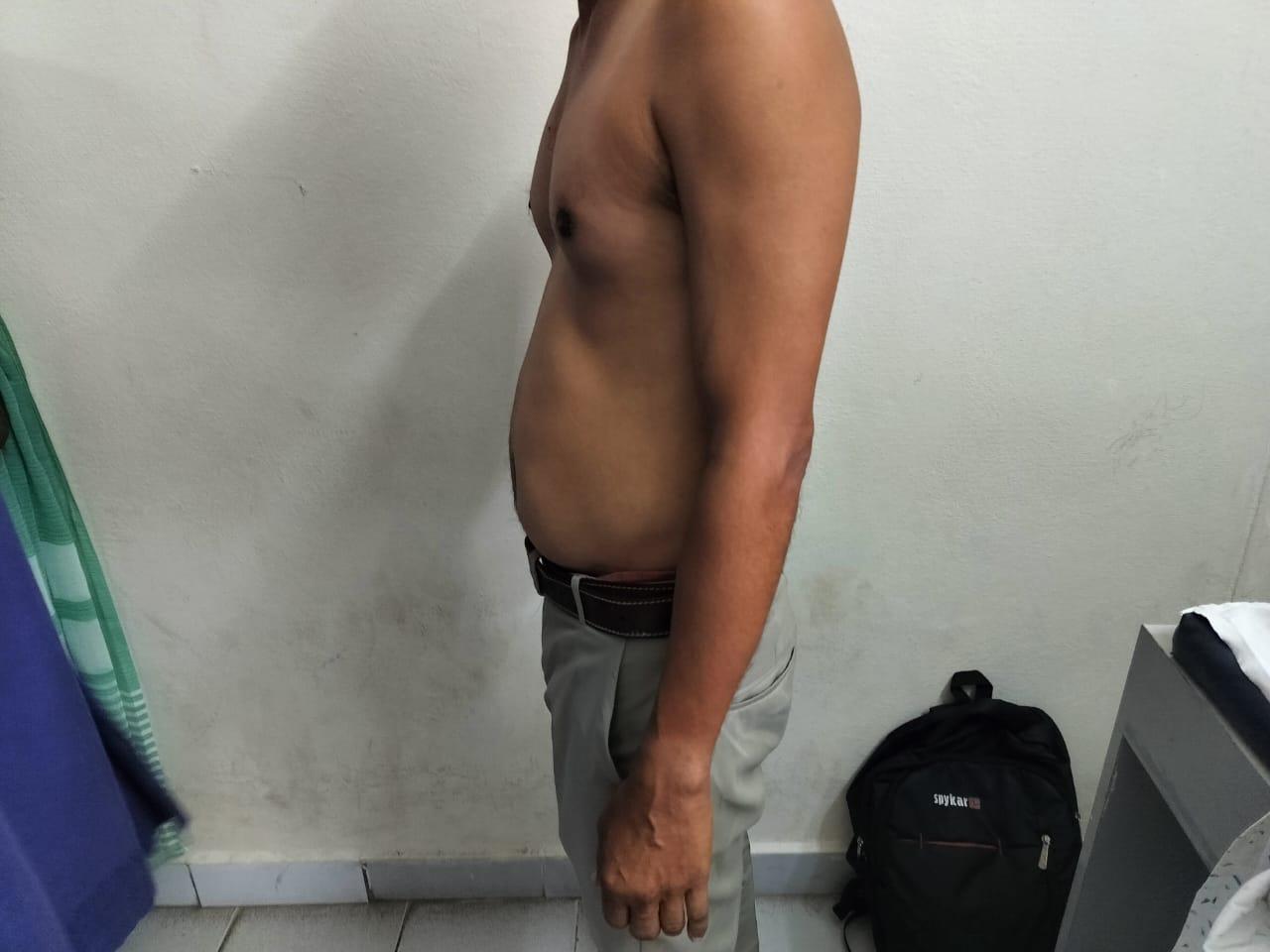 40M Painless gouty tophi 2 years Telangana PaJR