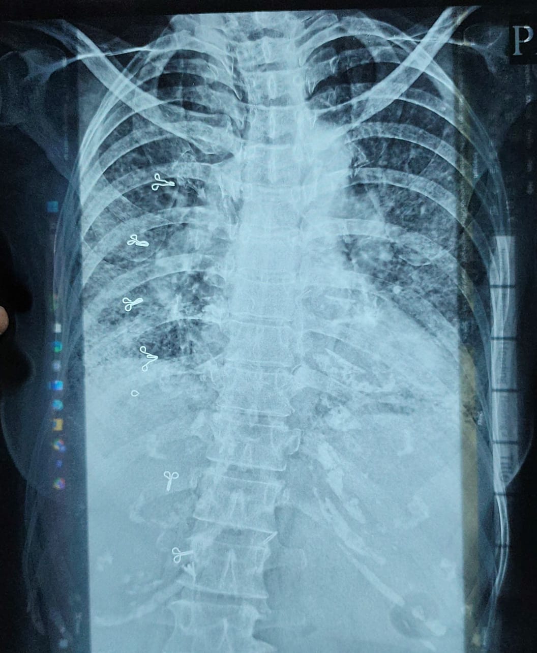 67F Dyspnea 2 yrs WB PaJR