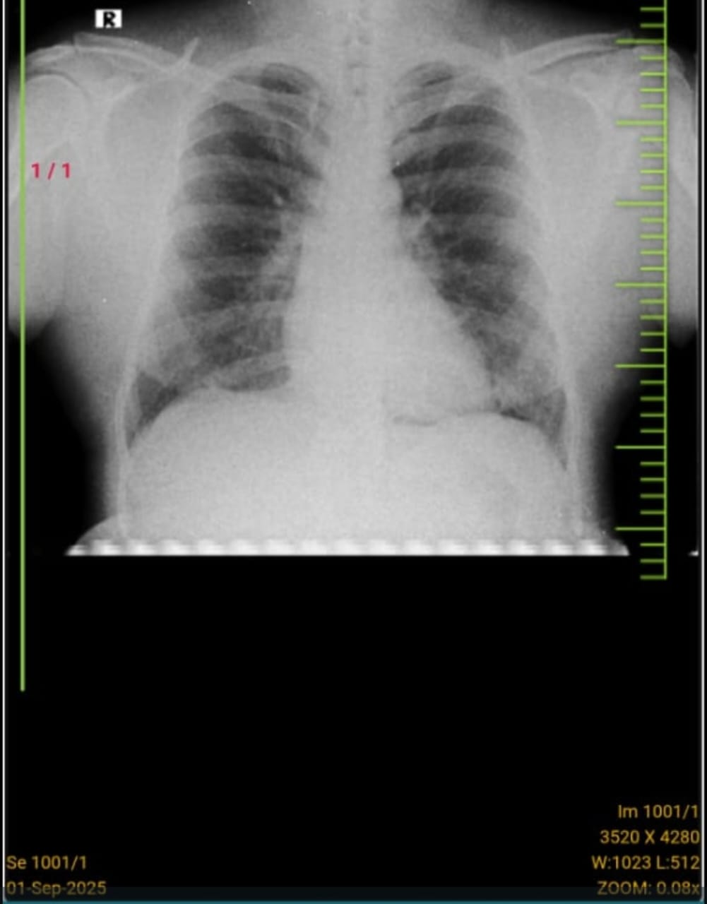 43M chest pain 3 mths 65M Neck pain torticollis 1 week, Telangana Family PaJR