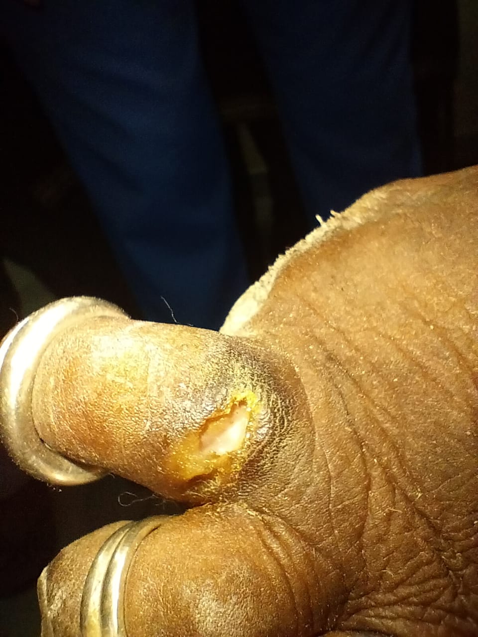48F Diabetes 8 years, Recent feet blister leading to gangrene, CKD insulin Telangana, PaJR