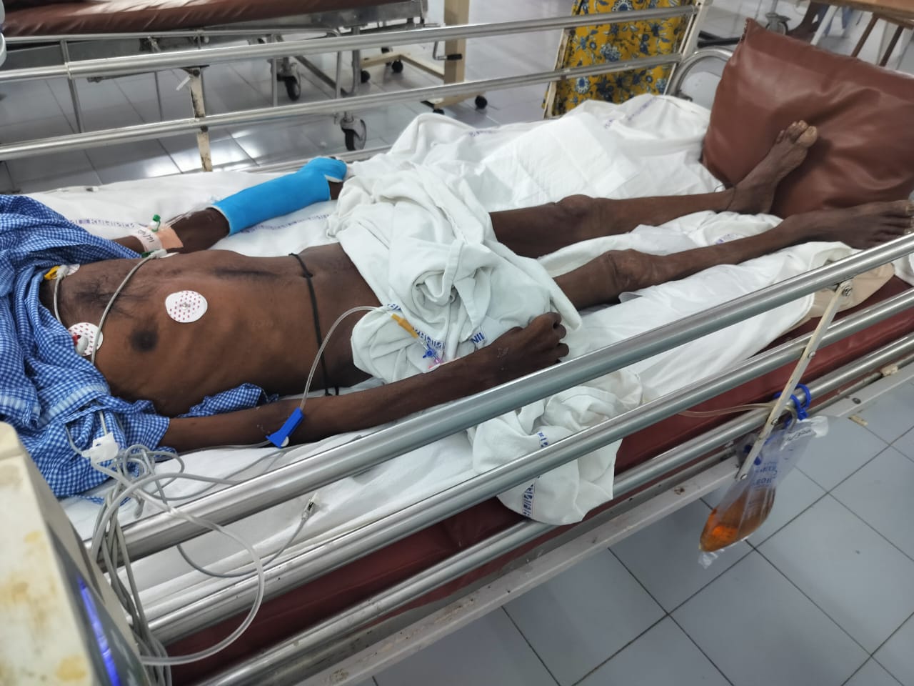 54M Alcoholism, altered sensorium, Hyponatremia,pulmonary edema, Telangana PaJR