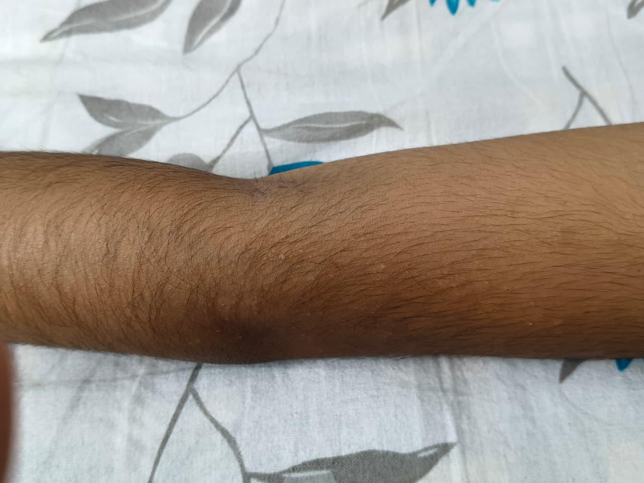 18F Post swimming papular non erythematous rash WB PaJR